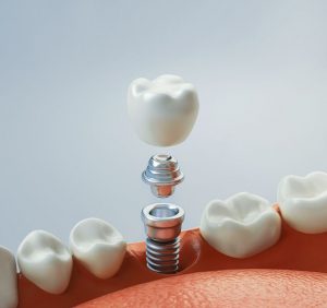 implantatzahnarzt_bouymin_nordbad